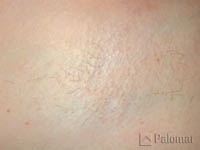 laser hair removal underarm after