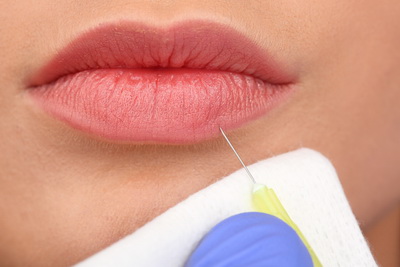 Lip Filler Injection