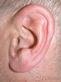 laser hair removal ear after