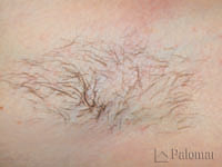 laser hair removal underarm before