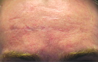 acne scar treatment - before