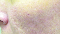 acne scar treatment - after