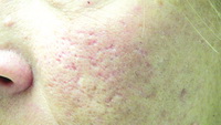 acne scar treatment - before