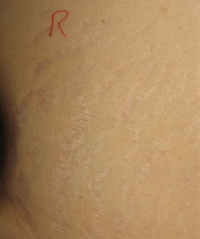 stretch mark after