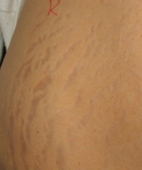 stretch mark before