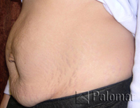 stretch mark before